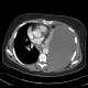 Collapse of lung wing, central tumour: CT - Computed tomography